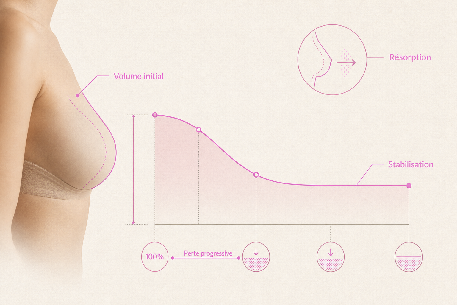 Infographie : Les limitations du lipofilling : résorption et volume